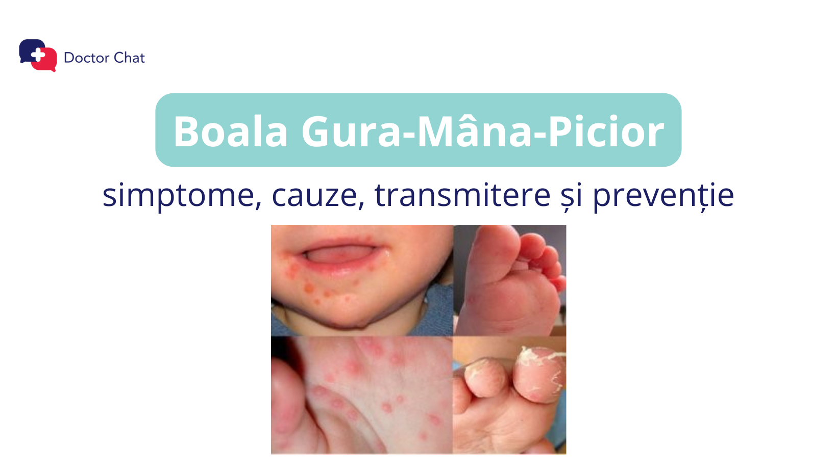 Boala Gura-Mână-Picior la copii: simptome, cauze, transmitere