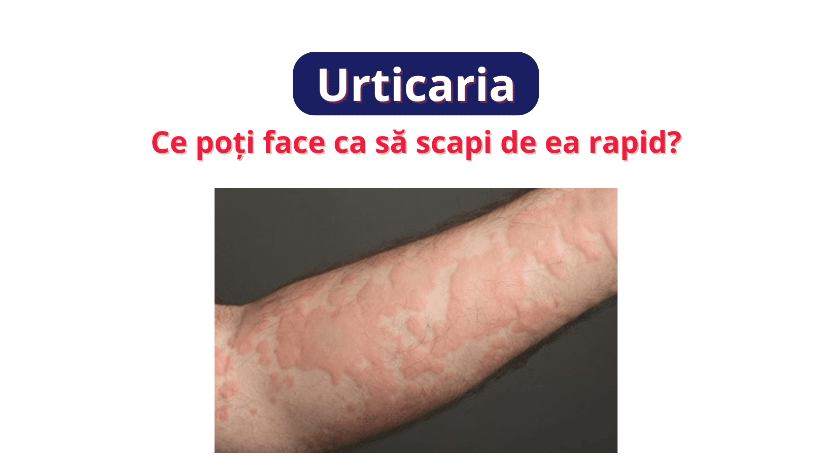 Urticaria: Ce poți face ca să scapi de ea rapid?